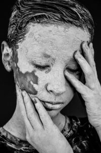 デリケートゾーンの脱毛後に気をつけるべき色素沈着のケア方法は？